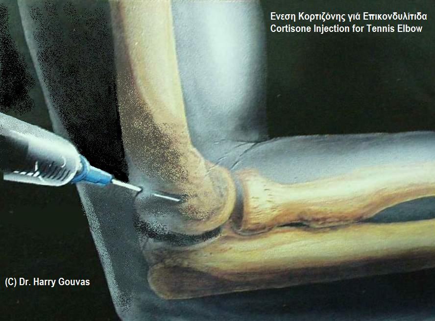 Cortisone_injection_for_tennis_elbow.jpg