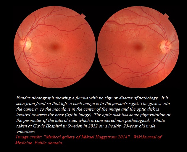 fundus photo with credit hydroxychloroquine.jpg