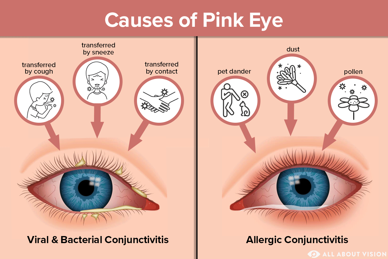 Conjunctivitis causes symptoms and treatment