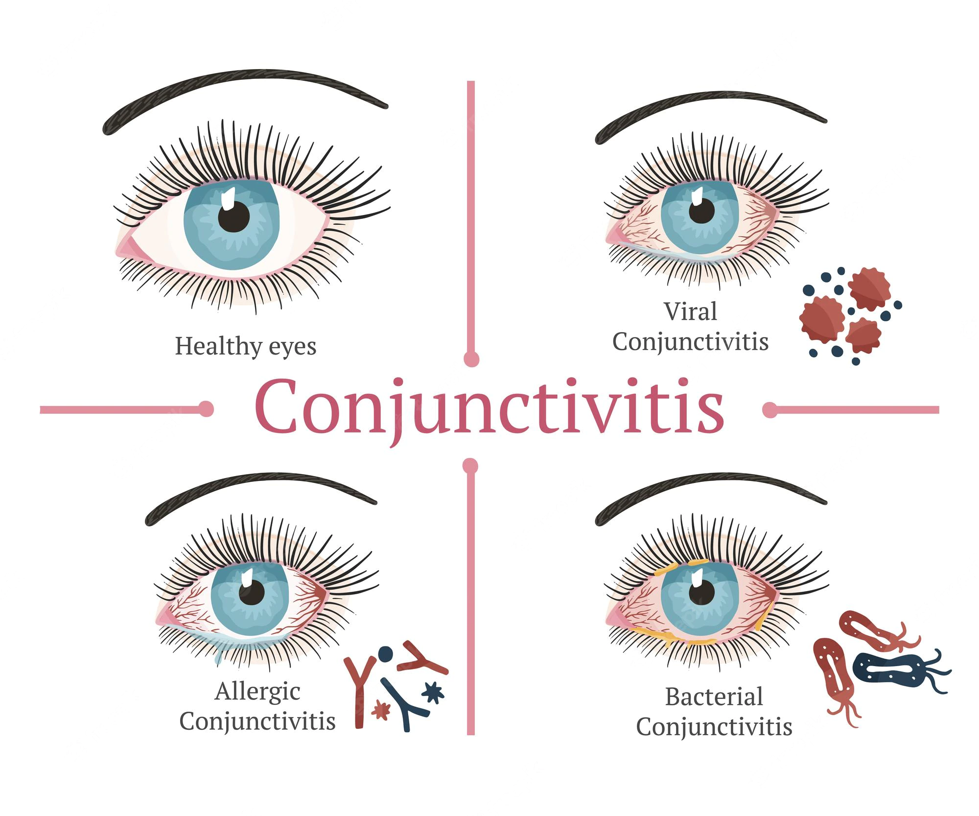 Conjunctivitis: Causes, Symptoms, and Treatment