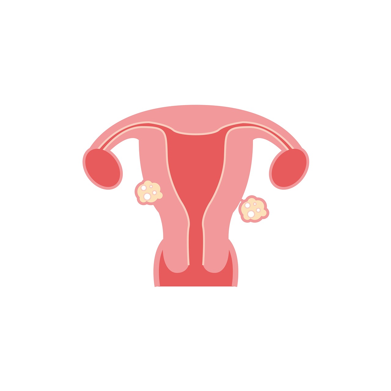 fibroids-2947710_1280.jpg