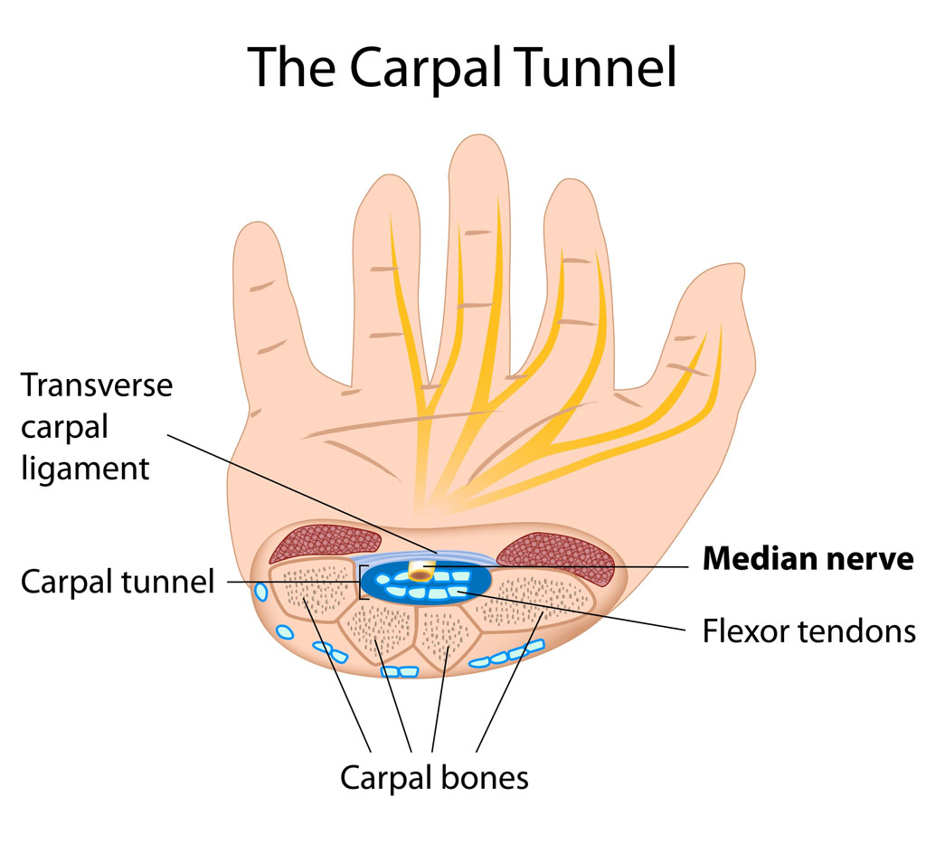 Carpal-tunnel-syndrome-779263028.jpg