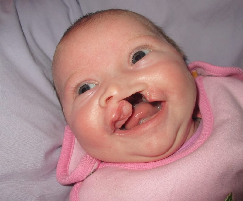 cleft-lip-and-palate-5-weeks-800x662(5).jpg