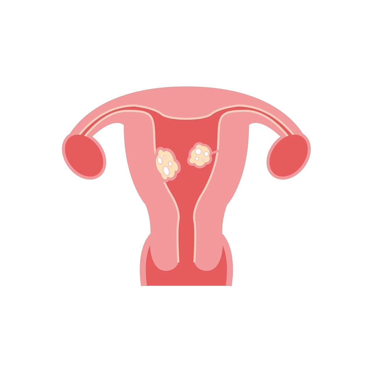 fibroids-2947712_1280.webp.jpg
