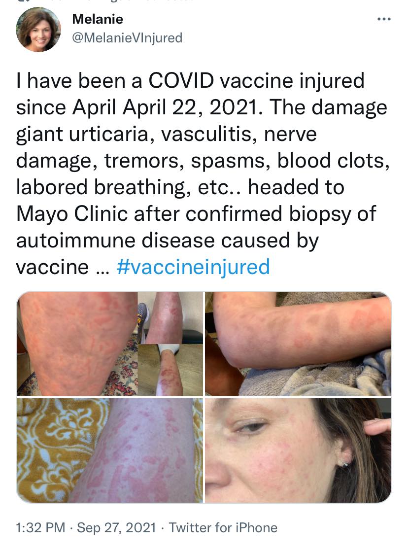 vax skin 20.jpg