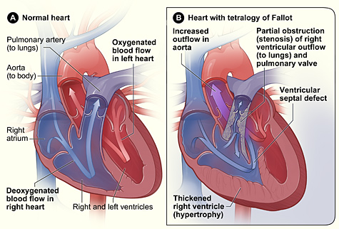 Tetralogy_fallot.jpg