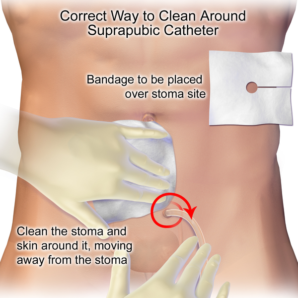 Cleaning_a_Suprapubic_Catheter.png