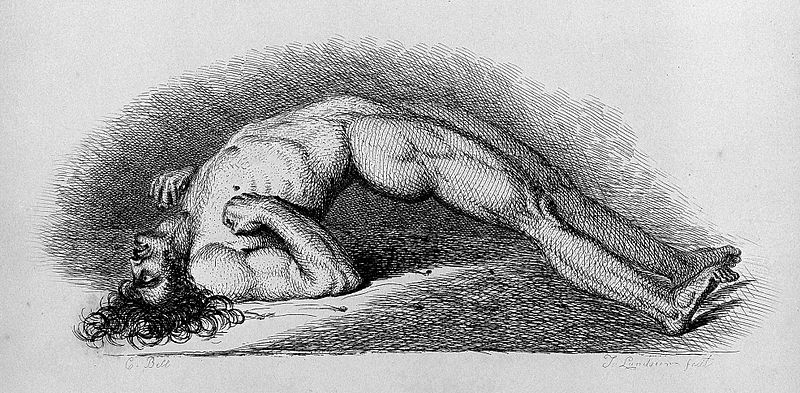 Patient_in_a_convulsion,_1847_Wellcome_L0005236.jpg