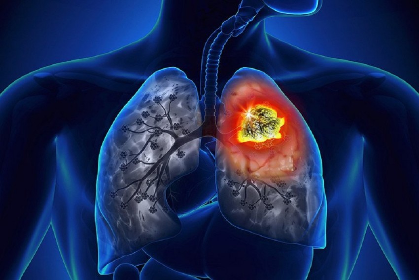 lung_cancer_570_850.jpg