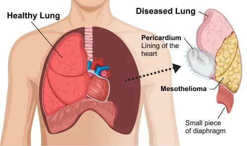extrapleural-pneumonectomy-epp-large.webp