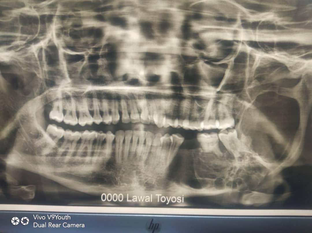X-ray .jpg