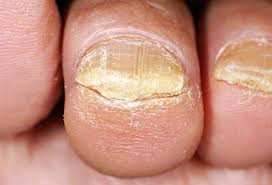 nail fungus.jpg