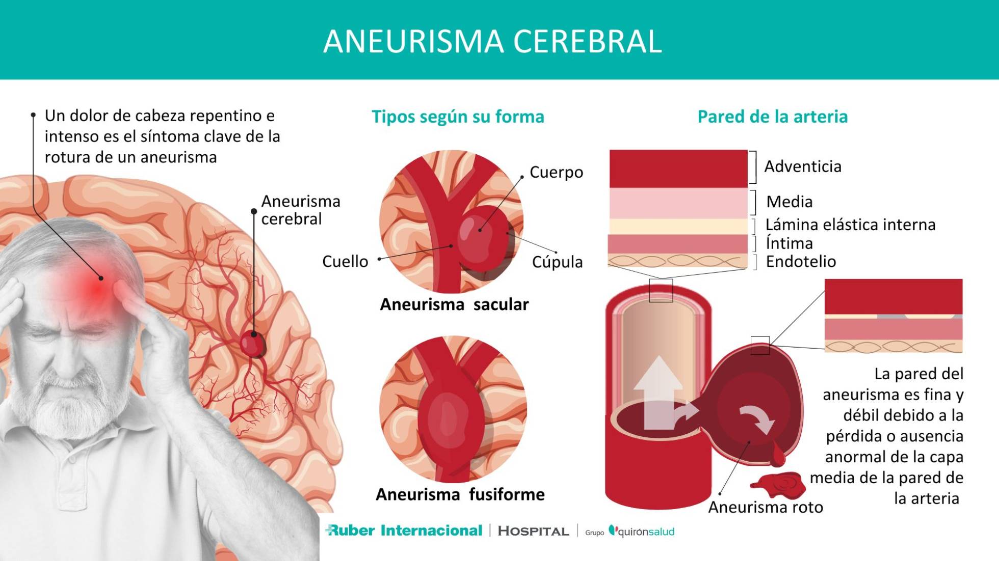 Qué es un aneurisma Cerebral.jpg