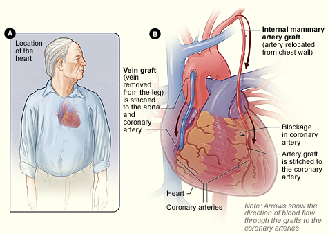 cabg.jpg