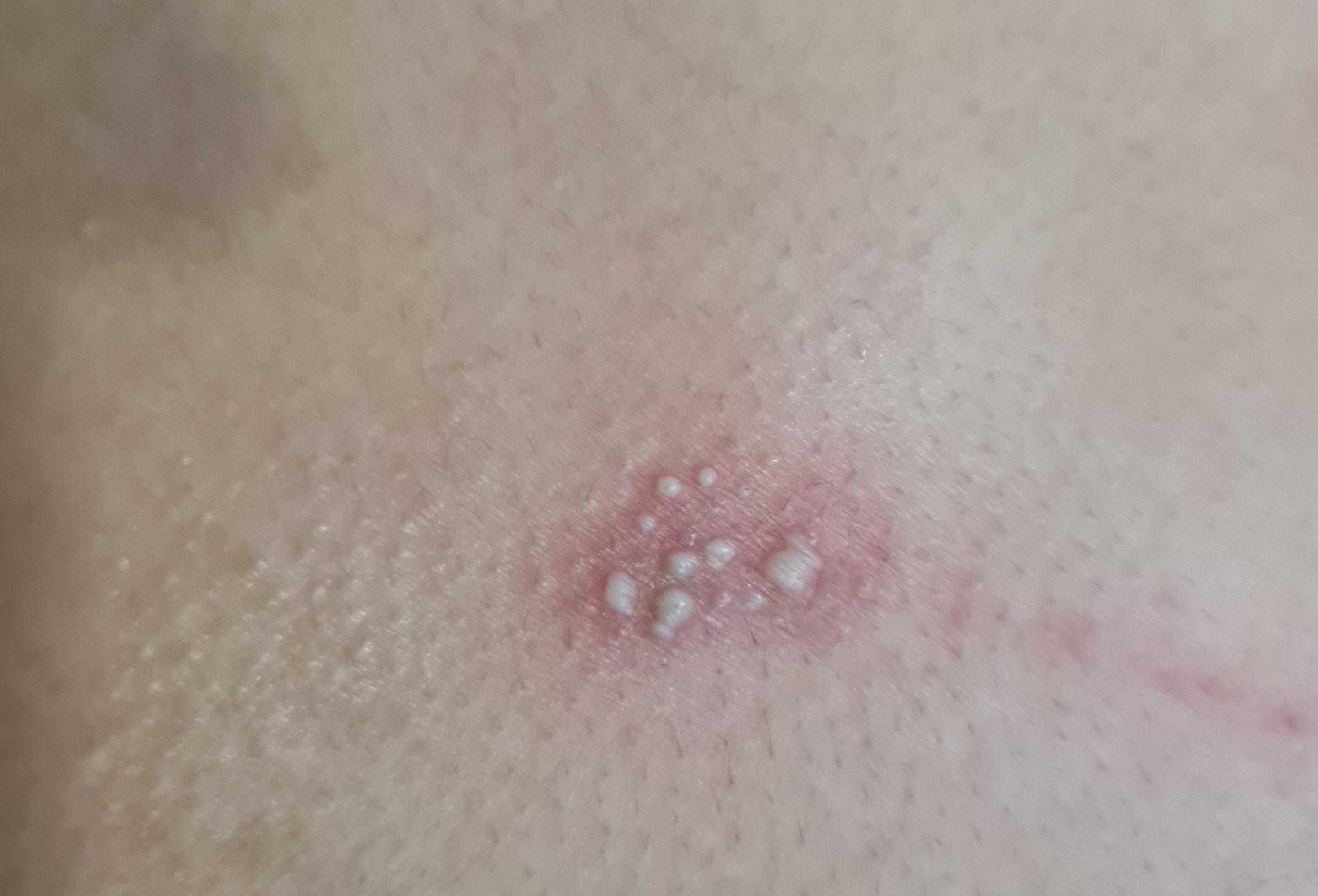Fire ant bite.jpg